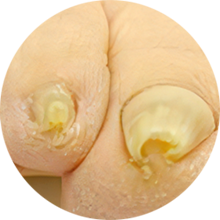 1つでも当てはまるなら「小田原巻き爪センター」がお役に立てます。